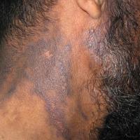 
	Lichen planus pigmentosus 