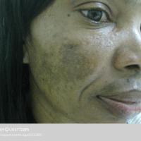 
	Melasma