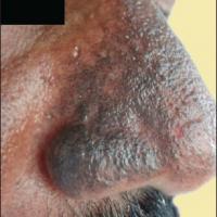 
	Exogenous ochronosis

	Same patient as…