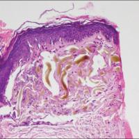 
	Exogenous ochronosis

	Histology shows…