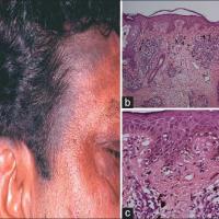 
	Riehl melanosis

	A contact allergic…