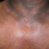 
	Erythema dyschromicum perstans