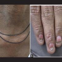 
	Dyskeratosis congenita

	a) lacy reticulate…