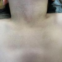 Terra firma-forme dermatosis
Copied with kind…