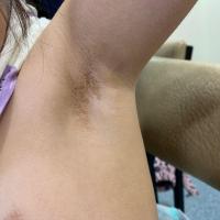 Terra firma-forme dermatosis - same…