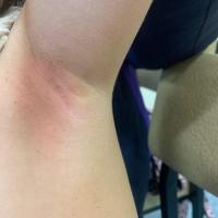 Terra firma-forme dermatosis - same case
Scale…