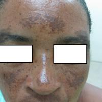 
	Melasma - epidermal 

	The lesions are darker…