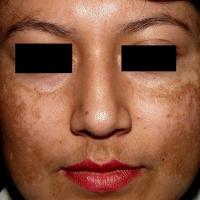 
	Melasma

	Copied with kind permission from…