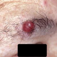 Merkel cell carcinoma