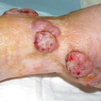 
	Merkel cell carcinoma - local metastases&nbsp;