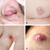 
	Merkel cell carcinoma

	A variety of…