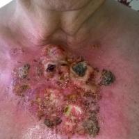 Merkel cell carcinomaA 12 month history - this…