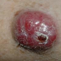 
	Merkel cell carcinoma

	Copied with kind…