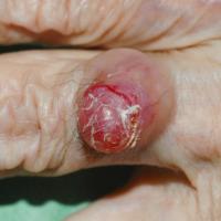 
	Merkel cell carcinoma

	Copied with kind…