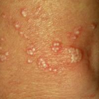 
	Milia resulting from sunburn