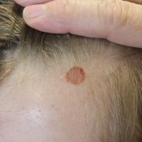 
	Acquired melanocytic naevus on the scalp, skin…