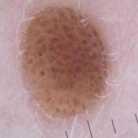 
	Dermoscopic appearance of  previous…