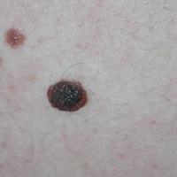 
	Dermal naevus

	This lesion had grown to take…