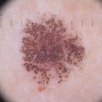 
	Dermoscopic appearance of  previous…