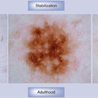 Predominantly reticular naevi - dermoscopic…