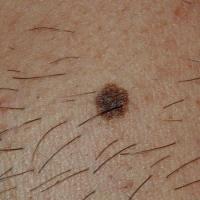 
	Acquired melanocytic naevus
	
	Copied with kind…