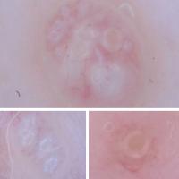 Dermoscopy of molluscumWhite circles with a clear…