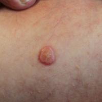 
	A large solitary molluscum contagiosum on the…