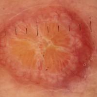 Dermoscopic image of the previous imageCentral…