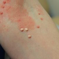 
	Molluscum contagiosum and liquid…