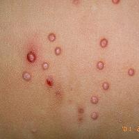 
	Molluscum contagiosum

	Copied with kind…