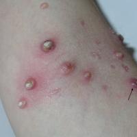 
	Molluscum contagiosum

	Arrow denotes an…
