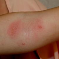 
	Molluscum contagiosum and atopic eczema