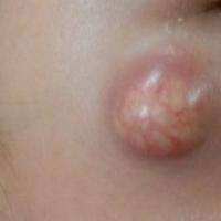 
	A giant molluscum
	
	&nbsp;