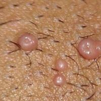 
	Molluscum contagiosum

	Umbilicated…