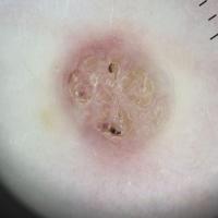 Molluscum contagiosumCentral white-yellow clods