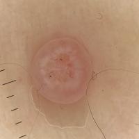 Another giant molluscum with central 'grapefruit'…