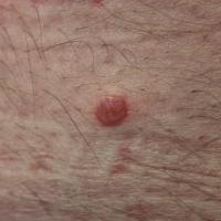
	Molluscum contagiosum in an adult