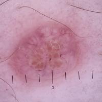 Dermoscopic appearance of the previous…