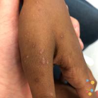 Molluscum contagiosum&nbsp;
Copied with…