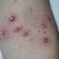 
	Molluscum contagiosum: pre-treatment with…