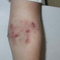 
	Same patient as figure 7 - one week of treatment