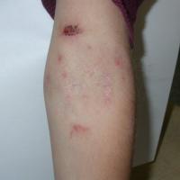 
	Same patient as figure 7 - two weeks of…