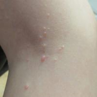 Molluscum contagiosum