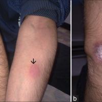 
	Tuberculous chancre from steroid…