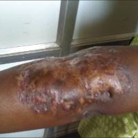 
	Tuberculous chancre following a road traffic…