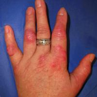 
	Atypical mycobacterial infection in an…