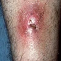 
	Tuberculous gumma 

	This presentation is…