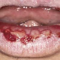 Mucosal features can&nbsp;associated with…