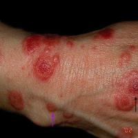 Lesions of erythema multiforme can be associated…