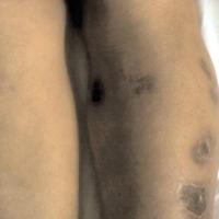 
	Aspergillus in a diabetic patient